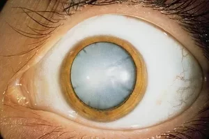 Cataracte